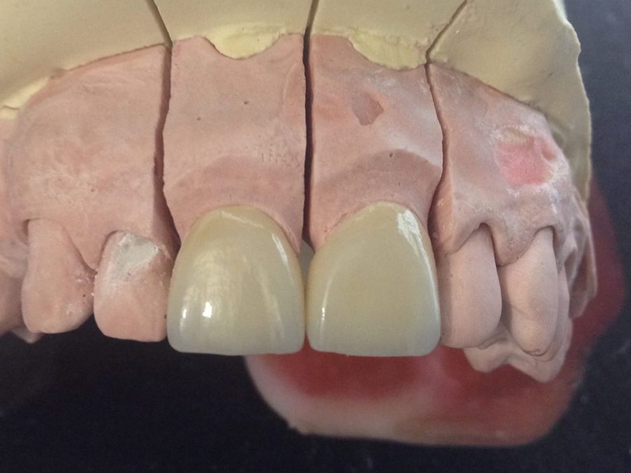 CORONAS EN ZIRCONIO CAD CAM